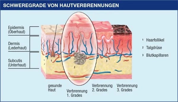Verbrennung Ersten Grades Erkennen Behandeln Bepanthen