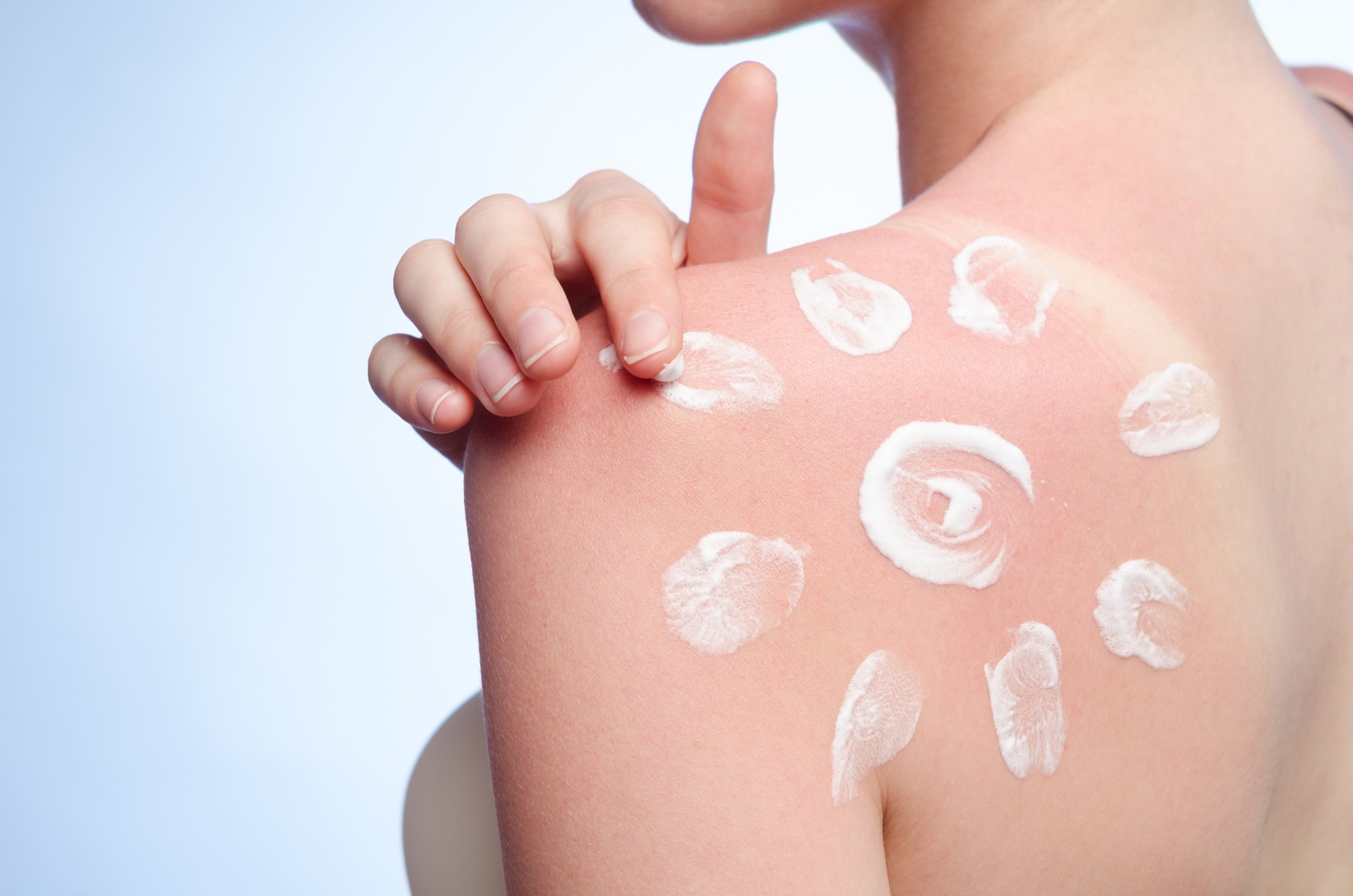 Haut Schält Sich Nach Sonnenbrand Trotzdem Braun Verbrennungen zweiten Grades erkennen & behandeln | Bepanthen®
