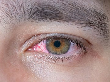 Bindehautentzündung: Symptome & Behandlung | Bepanthen®