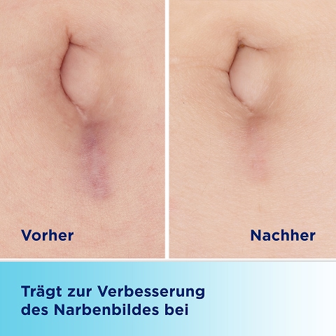 BepanCare® Narben-Gel